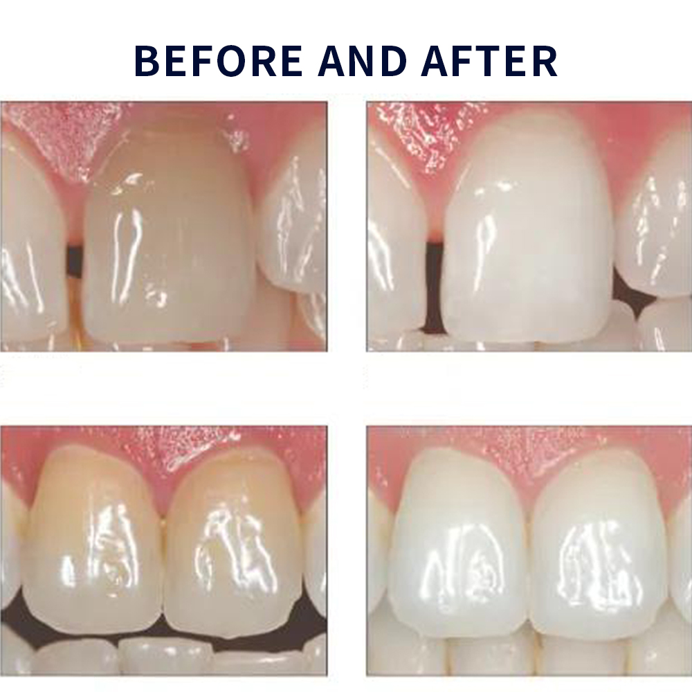 Opalescence Whitening 20% PF 2 – Teeth Whitening Price recenzja i cena