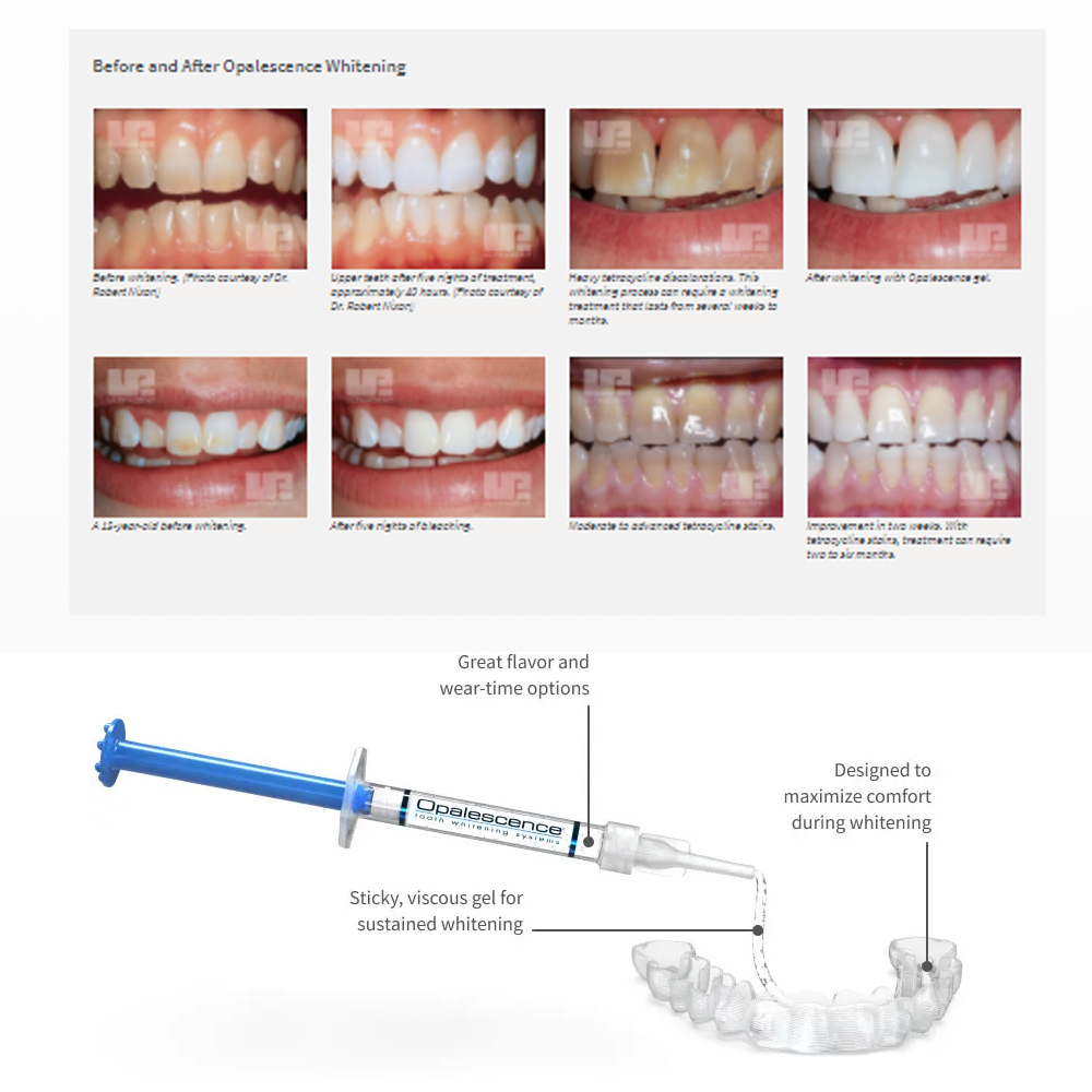 Opalescence Whitening 20% PF 2 – Teeth Whitening Price recenzja i cena