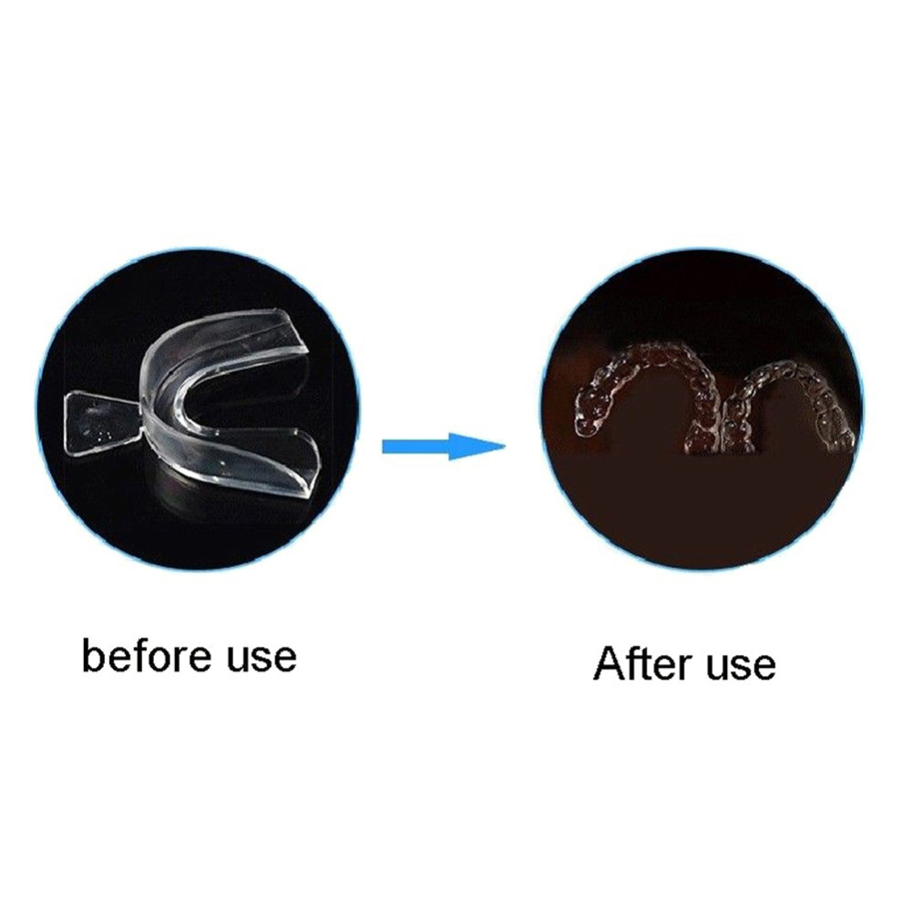 2/4 szt. Miękkie aparaty ortod – Teeth Whitening With Braces recenzja i cena
