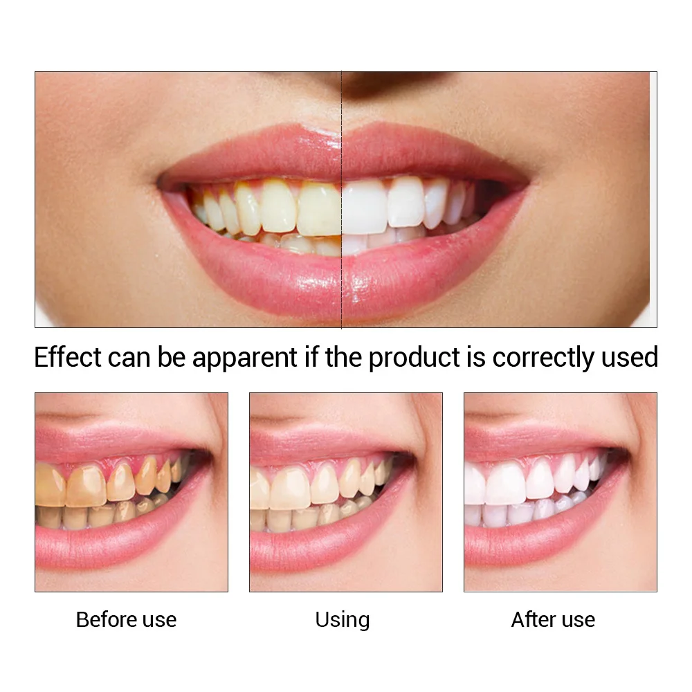 FTEENPLY esencja do wybielania – Teeth Whitening Price recenzja i cena