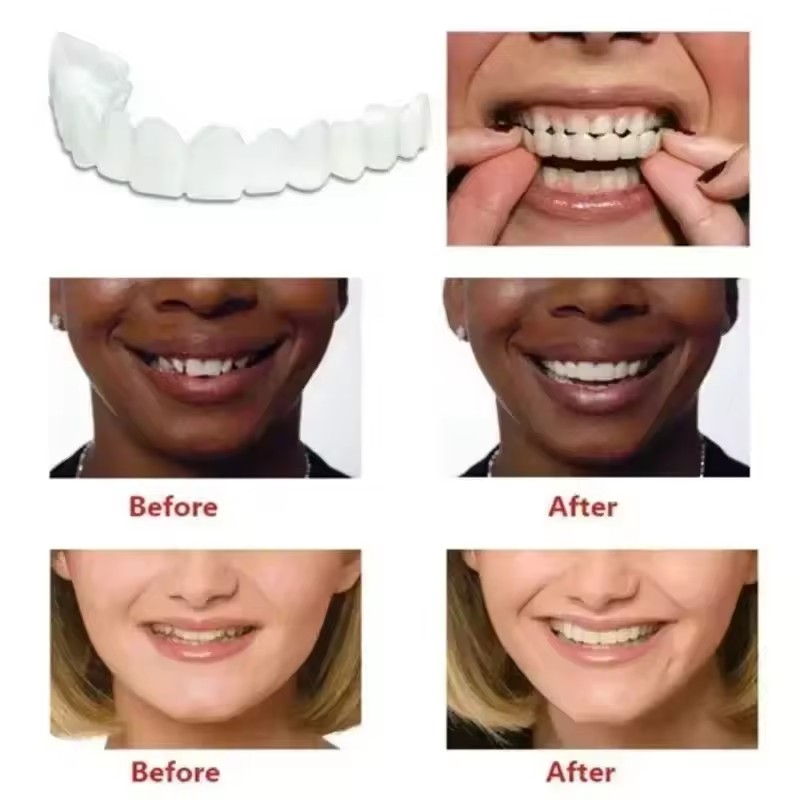 Okładziny na zęby Wybielanie z – Teeth Whitening Session recenzja i cena