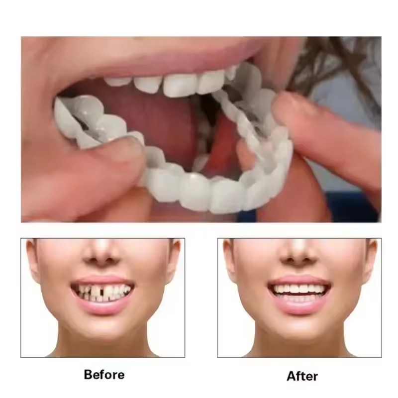 Okładziny na zęby Wybielanie z – Teeth Whitening Session recenzja i cena