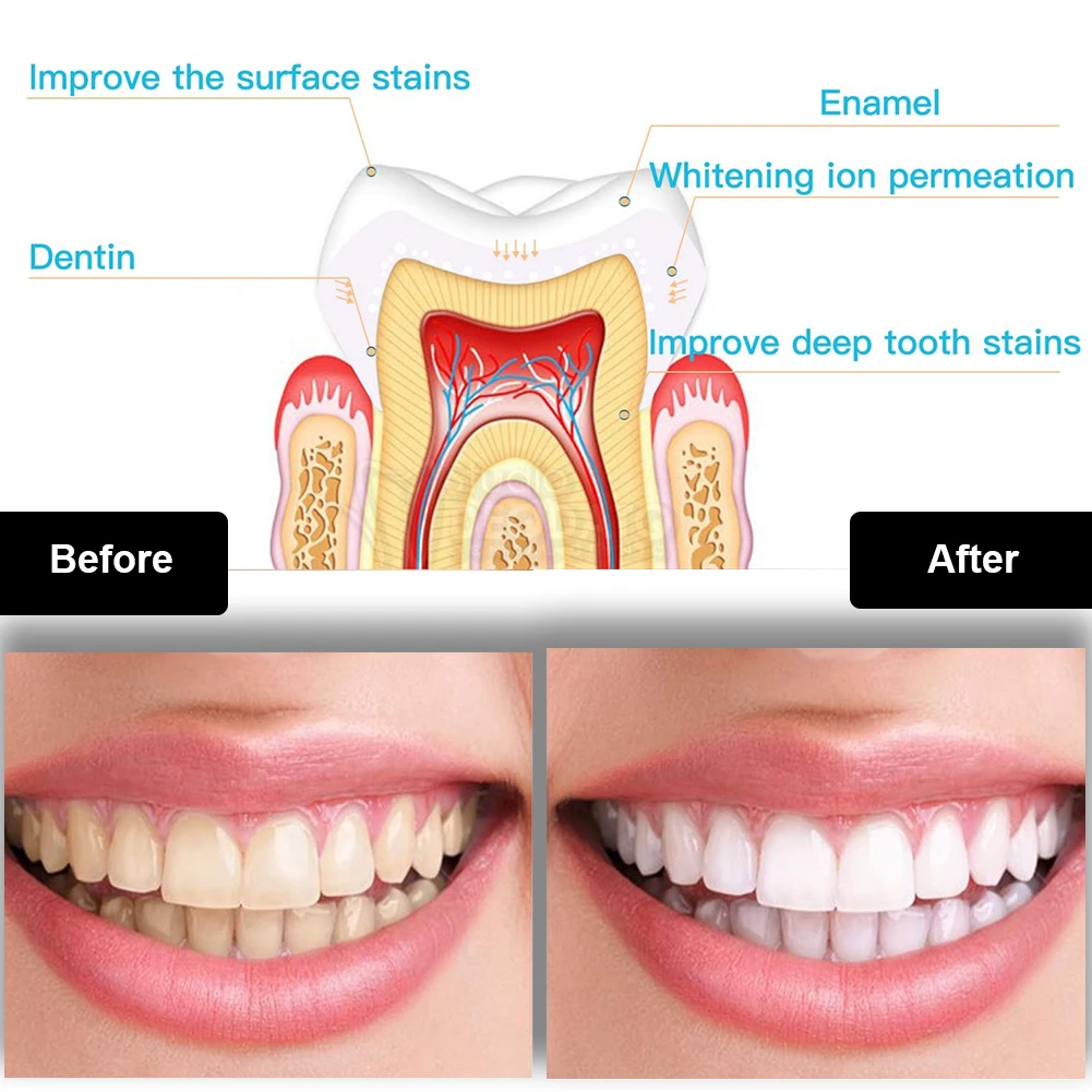 Zestaw do wybielania zębów den – Teeth Whitening At Home recenzja i cena